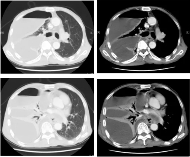 以脓气胸为首发症状的食管癌