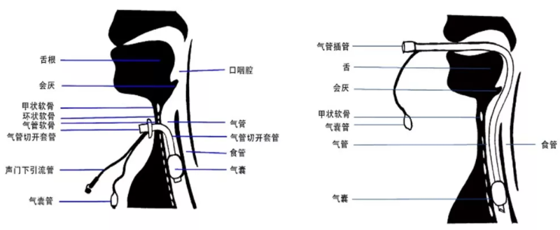 该患者采用声门下吸引方法进行引流.声门下吸引包括持续声门下